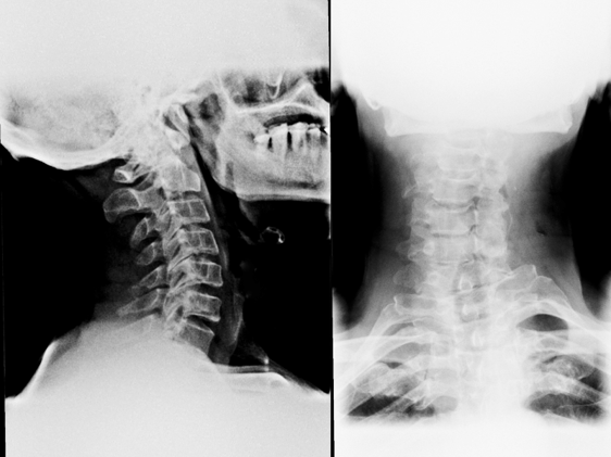 An x-ray that displays an auto accident victim suffering whiplash